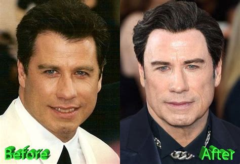 John Travolta Before and After Plastic Surgery